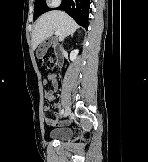 Adrenal myelolipoma (Radiopaedia 87794-104246 Sagittal renal cortical phase 35).jpg