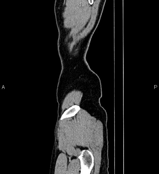 Adrenal myelolipoma (Radiopaedia 87794-104246 Sagittal renal cortical phase 96).jpg