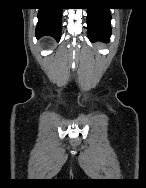 Adrenal myelolipoma - bilateral (Radiopaedia 74805-85810 Coronal C+ portal venous phase 64).jpg