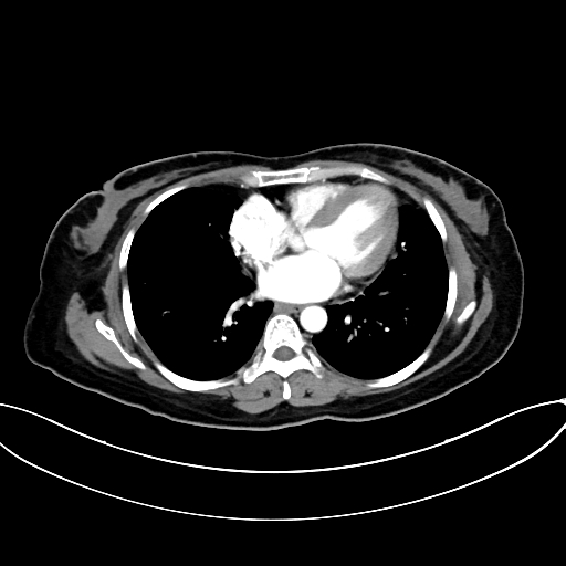 Adrenocortical carcinoma (Radiopaedia 87281-103569 Axial C+ arterial phase 6).jpg