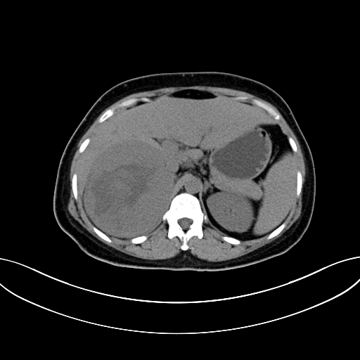 Adrenocortical carcinoma (Radiopaedia 87281-103569 Axial non-contrast 27).jpg