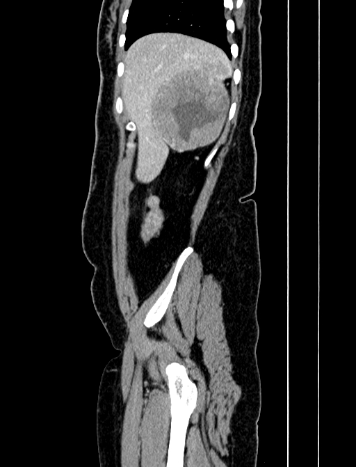 Adrenocortical carcinoma (Radiopaedia 87281-103569 Sagittal C+ portal venous phase 32).jpg