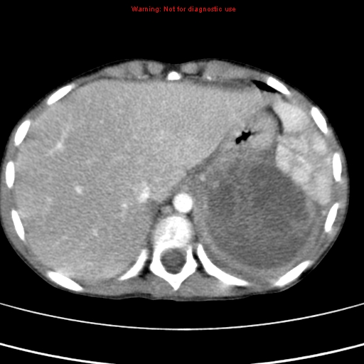 File:Adrenocortical carcinoma (Radiopaedia 9449-10131 Axial C+ portal venous phase 9).jpg