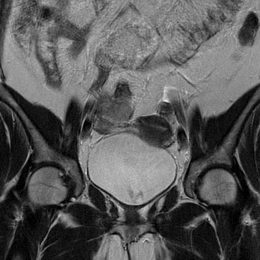 File:Adult granulosa cell tumor of the ovary (Radiopaedia 64991-73953 Coronal T2 9).jpg