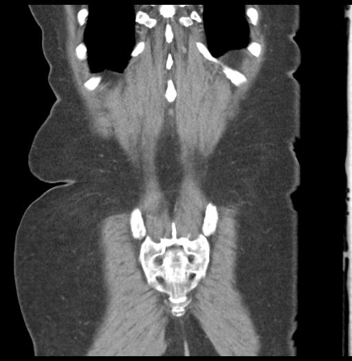 Adult ileal intussusception with secondary obstruction (Radiopaedia 30395-31051 Coronal C+ portal venous phase 56).jpg