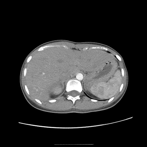 File:Adult polycystic kidney disease (Radiopaedia 48845-53876 Axial renal cortical phase 6).jpg