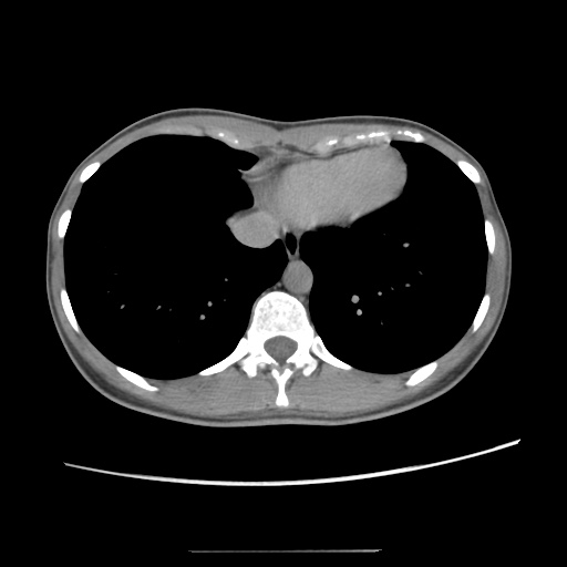 Adult polycystic kidney disease (Radiopaedia 48845-53876 Axial renal excretory phase 13).jpg
