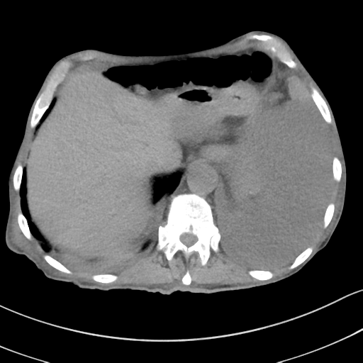 Advanced metastatic lung cancer (Radiopaedia 48910-53954 Axial non-contrast 56).png