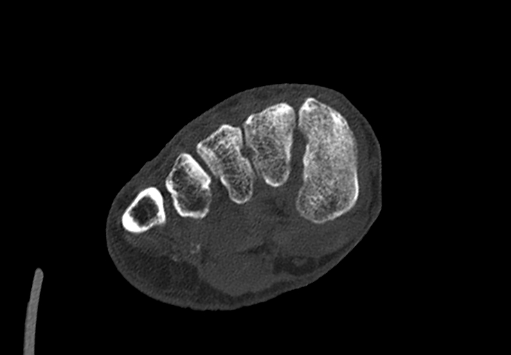 Advanced osteomyelitis due to open metatarsal fracture (Radiopaedia 83891-99095 Axial bone window 27).jpg