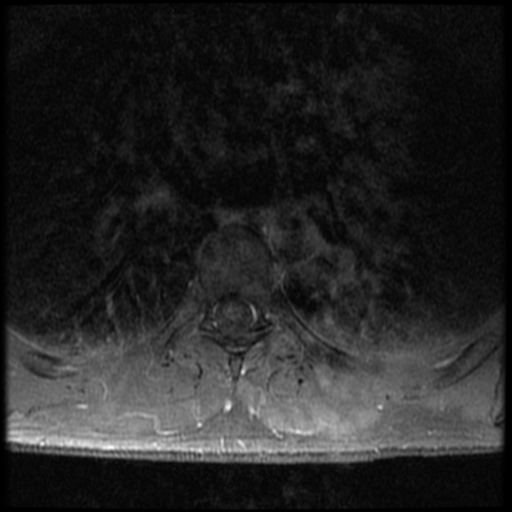 File:Aggressive vertebral hemangioma (Radiopaedia 39937-42404 Axial T1 C+ fat sat 21).png