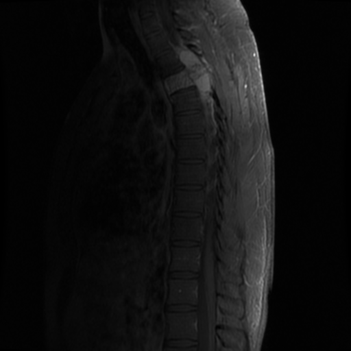 File:Aggressive vertebral hemangioma (Radiopaedia 39937-42404 B 11).png