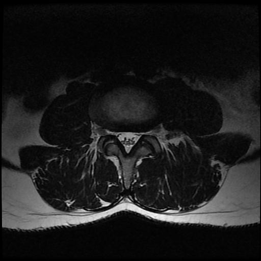 File:Aggressive vertebral hemangioma with pathological fracture (Radiopaedia 69528-79411 Axial T2 8).jpg