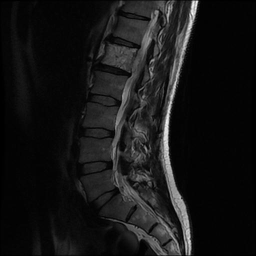 File:Aggressive vertebral hemangioma with pathological fracture (Radiopaedia 69528-79411 Sagittal T2 4).jpg