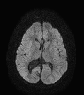 File:Aicardi syndrome (Radiopaedia 66029-75205 Axial DWI 13).jpg