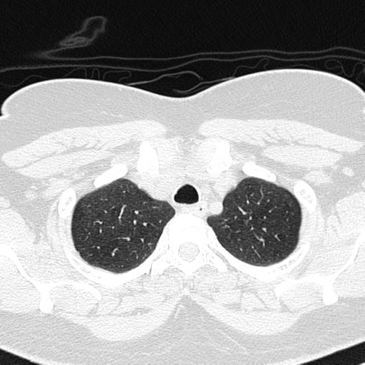 Air trapping in small airway disease (Radiopaedia 61685-69694 Axial lung window 26).jpg