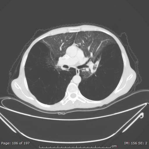 Alpha-1-antitrypsin deficiency (Radiopaedia 50561-55987 Axial lung window 44).jpg