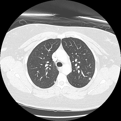 Alveolar soft part sarcoma - right leg (Radiopaedia 59432-67091 Axial lung window 37).jpg