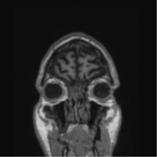Alzheimer's disease- with Gerstmann syndrome and dressing apraxia (Radiopaedia 54882-61150 Coronal T1 84).png