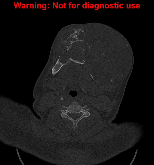 File:Ameloblastoma (Radiopaedia 33126-34164 Axial bone window 21).jpg