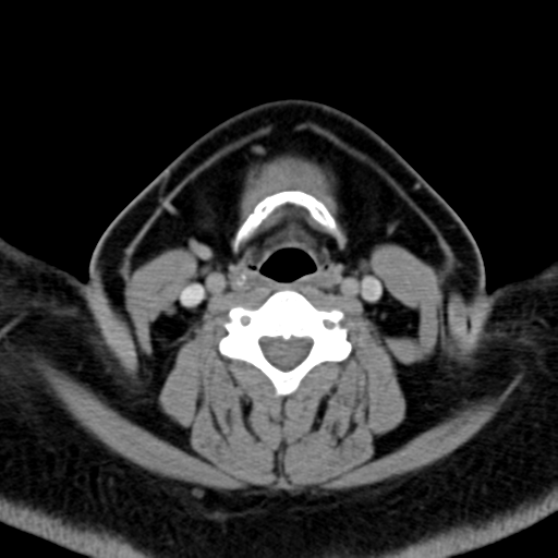 Ameloblastoma (Radiopaedia 38520-40623 Axial non-contrast 45).png