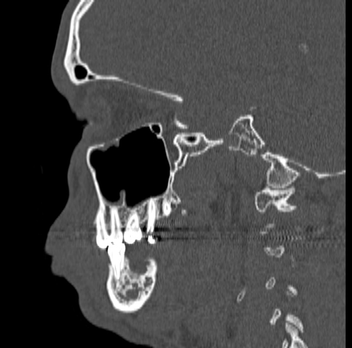 Ameloblastoma (Radiopaedia 77750-89997 Sagittal bone window 31).jpg