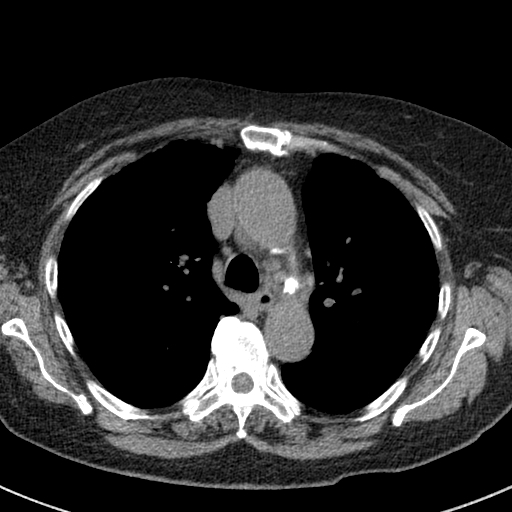 File:Amiodarone-induced pulmonary fibrosis (Radiopaedia 82355-96460 Axial non-contrast 24).jpg