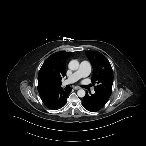 Ampullary adenocarcinoma (Radiopaedia 59373-66734 C 2).jpg