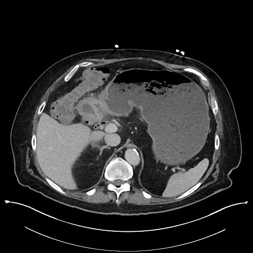 Ampullary adenocarcinoma (Radiopaedia 59373-66737 A 47).jpg