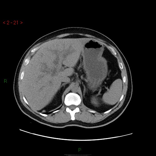 File:Ampullary carcinoma (Radiopaedia 56396-63056 Axial non-contrast 14).jpg