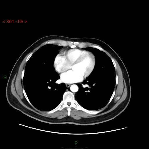 File:Ampullary carcinoma (Radiopaedia 56396-63056 B 2).jpg