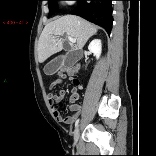 Ampullary carcinoma (Radiopaedia 56396-63056 D 40).jpg