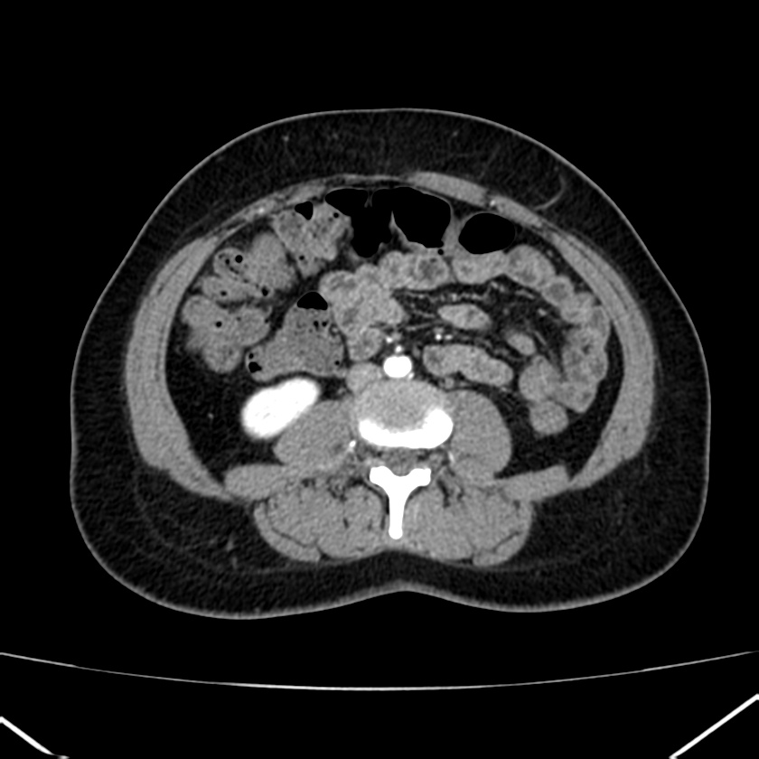 Ampullary tumor (Radiopaedia 22787-22816 B 52).jpg
