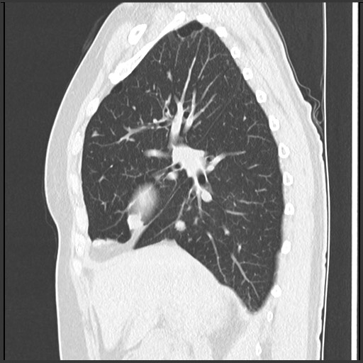 Amyloidosis - bronchial and diffuse nodular pulmonary involvement (Radiopaedia 60156-67744 F 21).jpg