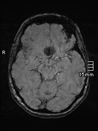 Amyotrophic lateral sclerosis (Radiopaedia 70821-81017 Axial SWI 19).jpg
