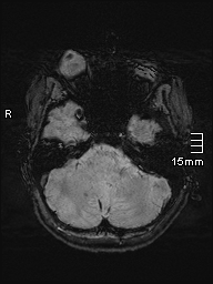 Amyotrophic lateral sclerosis (Radiopaedia 70821-81017 Axial SWI 6).jpg