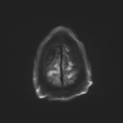 Amyotrophic lateral sclerosis (Radiopaedia 87352-103658 Axial DWI 55).jpg
