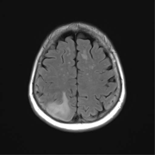 File:Anaplastic astrocytoma (Radiopaedia 86943-103160 Axial FLAIR 22).png