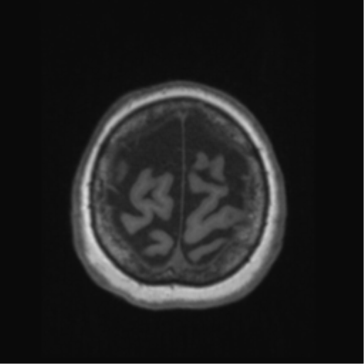 Anaplastic astrocytoma IDH wild-type (pseudoprogression) (Radiopaedia 42209-45276 Axial T1 132).png