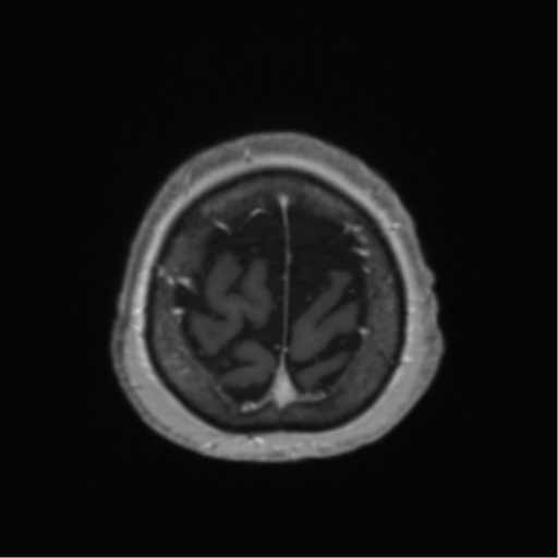 Anaplastic astrocytoma IDH wild-type (pseudoprogression) (Radiopaedia 42209-45278 Axial T1 C+ 137).png