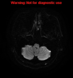 File:Anaplastic ganglioglioma (Radiopaedia 44921-48831 Axial DWI 3).jpg