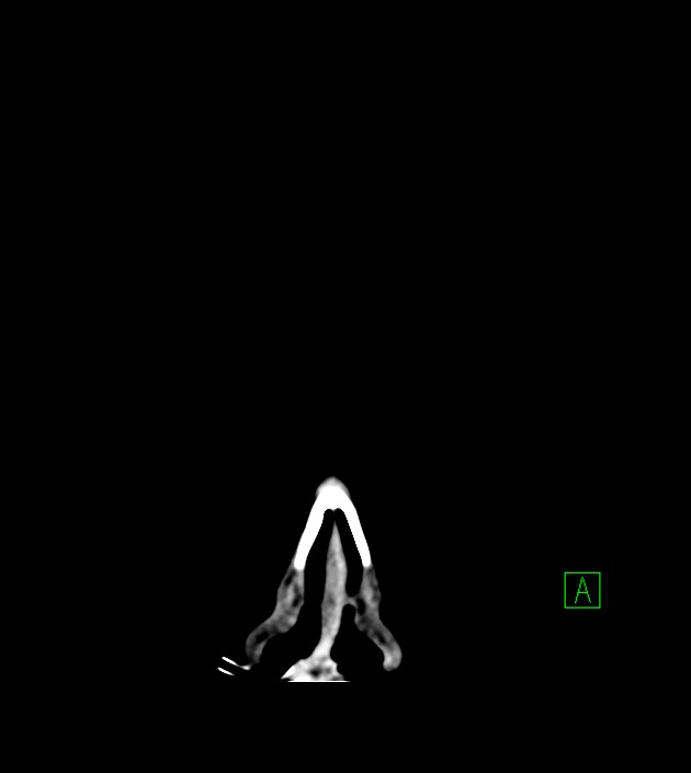 Anaplastic oligodendroglioma (Radiopaedia 79571-92758 Coronal non-contrast 3).jpg
