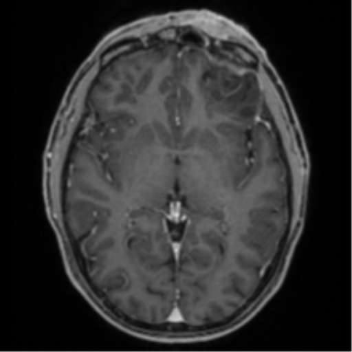 Anaplastic oligodendroglioma with skull fracture (Radiopaedia 74831-85845 Axial T1 C+ fat sat 30).png