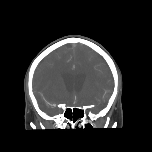 Aneursym related subarachnoid hemorrhage with hydrocephalus (Radiopaedia 45105-49084 B 29).jpg