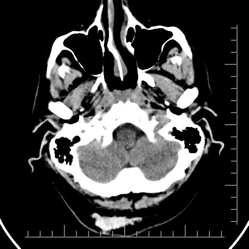 File:Aneurysm of posterior communicating artery (Radiopaedia 20188-20162 Axial non-contrast 6).jpg