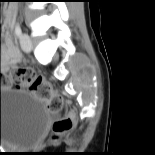 File:Aneurysmal bone cyst - sacrum (Radiopaedia 65190-74195 A 10).jpg
