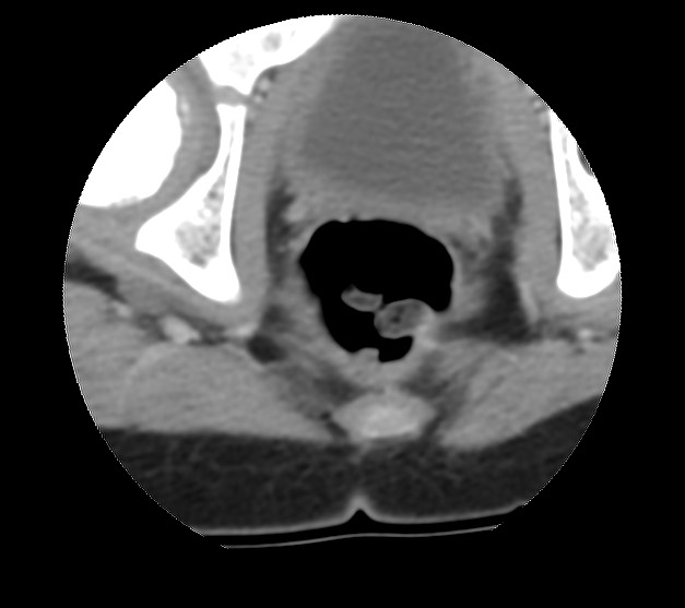 Aneurysmal bone cyst - sacrum (Radiopaedia 65190-74195 Axial non-contrast 48).jpg