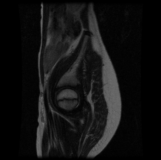 File:Aneurysmal bone cyst - sacrum (Radiopaedia 65190-74196 Sagittal T2 6).jpg