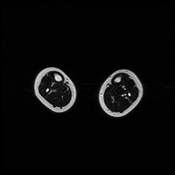 File:Aneurysmal bone cyst - tibia (Radiopaedia 22343-22367 Axial T2 4).jpg