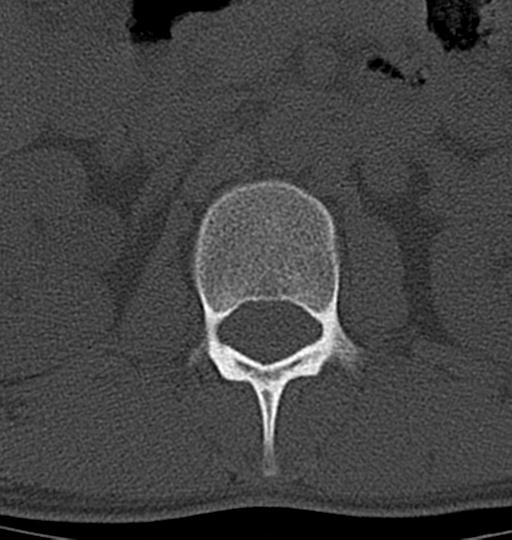 Aneurysmal bone cyst T11 (Radiopaedia 29294-29721 Axial bone window 66).jpg