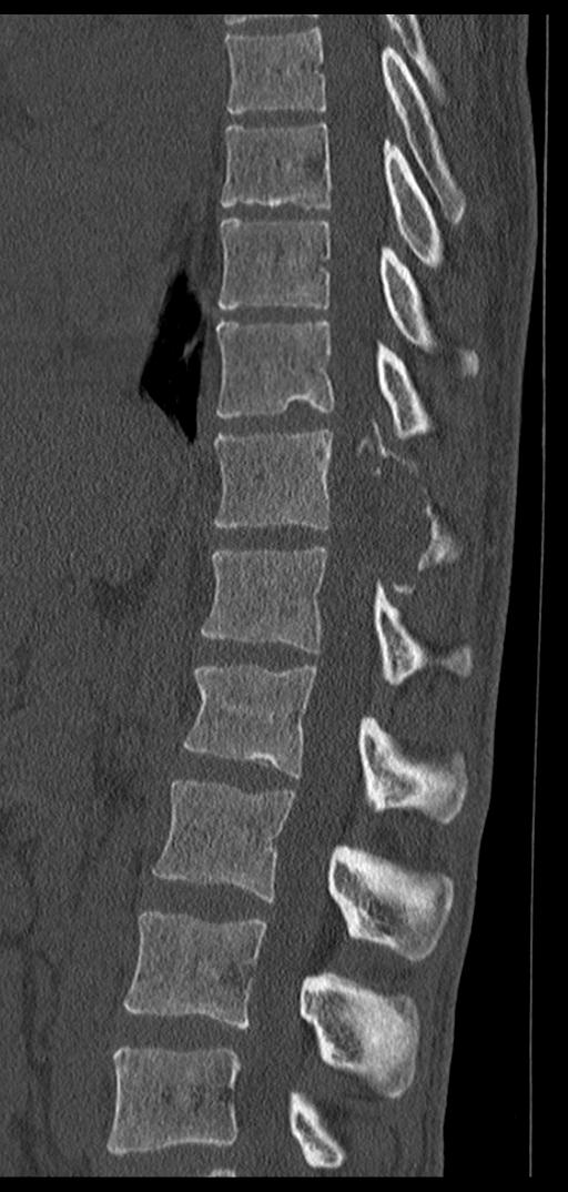 Aneurysmal bone cyst T11 (Radiopaedia 29294-29721 Sagittal bone window 41).jpg